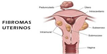 Fibromas Intrauterinos