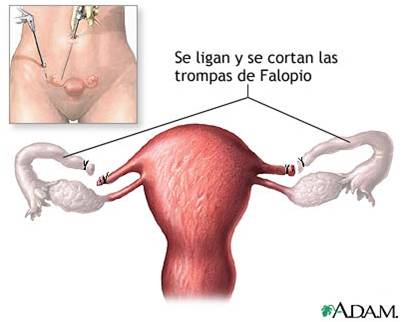 esterilizacion