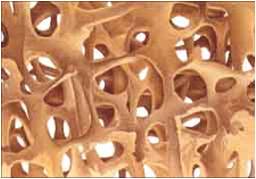 osteoporosis