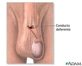 vasectomia